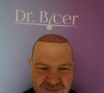 Dr Bicer Hair Tair transplant Turkey3.jpg