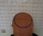 Dr Bicer Hair Tair transplant Turkey18.jpg