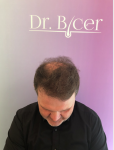 Dr Bicer Hair Tair transplant Turkey7.png
