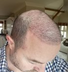 Dr Sethi Hair Transplant.jpg