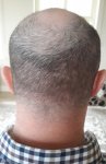 Dr Sethi Hair Transplant1.jpg