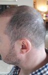 Dr Sethi Hair Transplant2.jpg