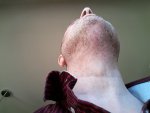 Dr Sethi Hair Transplant4.jpg