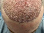 DR.PRADEEP SETHI Hair Transplant1.jpg