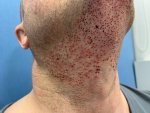 DR.PRADEEP SETHI Hair Transplant2.jpg