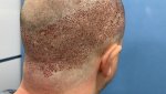 DR.PRADEEP SETHI Hair Transplant3.jpg
