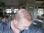 DR.PRADEEP SETHI Hair Transplant4.jpg