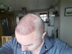 DR.PRADEEP SETHI Hair Transplant5.jpg