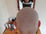 SMP Fading with laser treatment..jpg