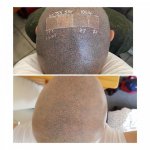 SMP before and after laser treatment.jpg