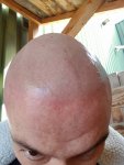 SMP after laser treatment.jpg
