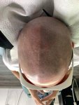 SMP removal during laser treatment.jpeg