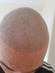 SMP 2 weeks after 1st laser session.jpg