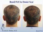 hair transplant scar.jpg