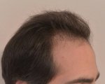 hattingen hair transplant-Dr muresanu3.jpg