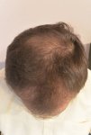 hattingen hair transplant-Dr muresanu4.jpg