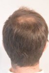 hattingen hair transplant-Dr muresanu5.jpg