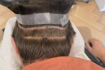 hattingen hair transplant-Dr muresanu6.jpg