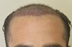 hattingen hair transplant-Dr muresanu7.jpg