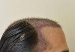 hattingen hair transplant-Dr muresanu9.jpg