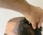 hattingen hair transplant-Dr muresanu10.jpg