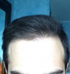 hattingen hair transplant-Dr muresanu 5 momths post op.jpg