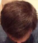 hattingen hair transplant-Dr muresanu 5 momths post op4.jpg