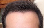hattingen hair transplant-Dr muresanu 6 momths post op.jpg