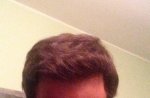hattingen hair transplant-Dr muresanu 13 momths post op2.jpg