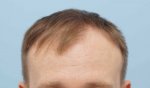 Before hair transplant.jpg
