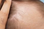 Before hair transplant2.jpg