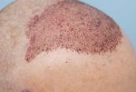 post op FUE hair transplant.jpg