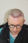 8b Second treatment New hair line.jpg
