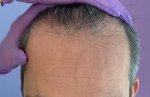 Dr Bicer hair tansplant.jpg