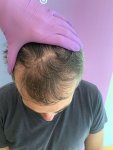 Dr Bicer hair transplant 1.jpg