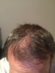 Dr Bicer hair transplant 2.jpg