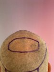 Dr Bicer hair transplant 5.jpg