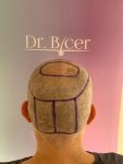 Dr Bicer hair transplant 7.jpg
