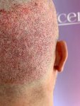Dr Bicer hair transplant 8.jpg