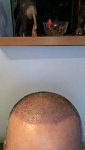 Dr Bicer hair transplant 9.jpg