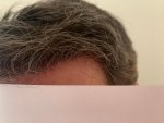 Dr Bicer hair transplant 10.jpg