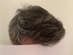 Dr Bicer hair transplant 11.jpg