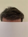 Dr Bicer hair transplant 12.jpg