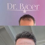 Dr Bicer hair transplant 14.jpg