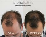 dieter v hair boost frontal area.jpg