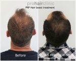 dieter v hair boost crown area.jpg
