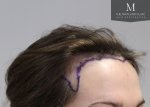 The Maitland Clinic Review5_FUT_After-right45.jpg