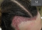 The Maitland Clinic Review27_Surgery_right-45_hairline.jpg
