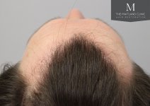 The Maitland Clinic - After_hairline.jpg