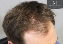 The Maitland Clinic - Before_right_Hairline.jpg